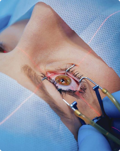 Cirurgia de Catarata