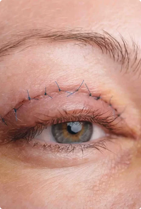 Blefaroplastia