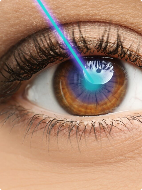 Cirurgia Refrativa